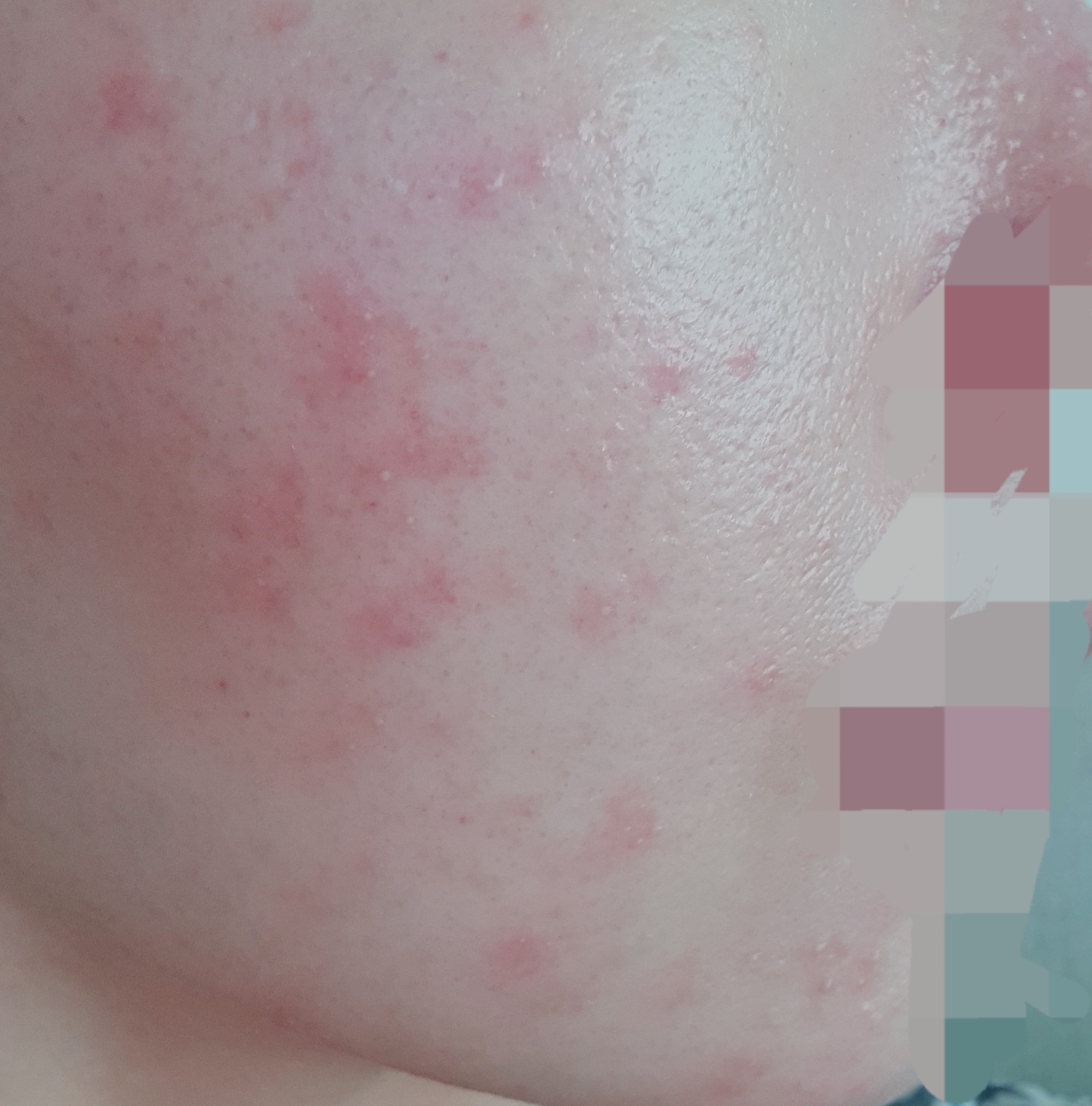  피코프락셀 8회째 후기 (얼굴 다 뒤집어짐) 비포애프터 사진. 부작용?