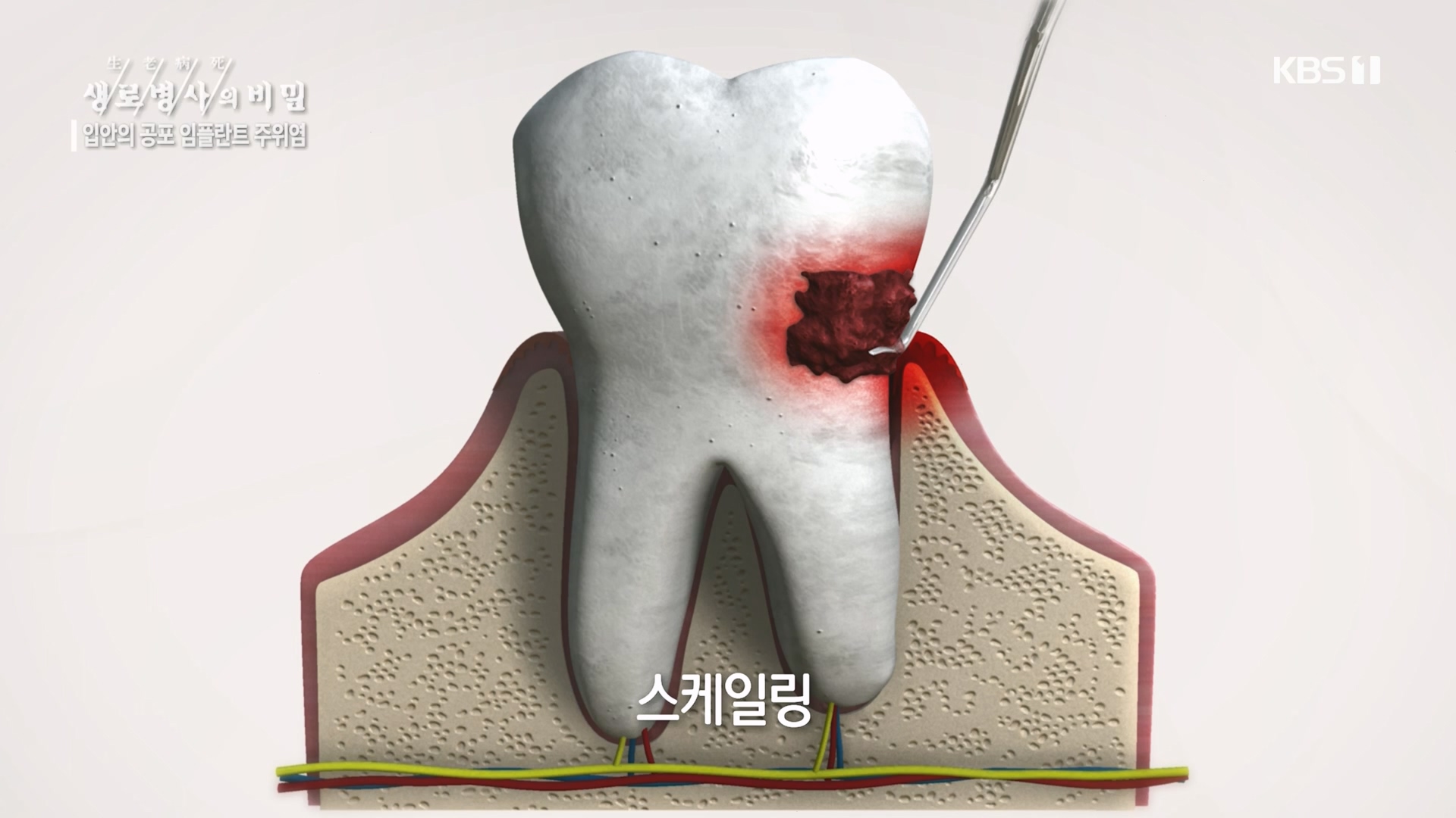 생로병사의 비밀.E890.231213p.H264-F1RST.mp4_20231214_201921.555.jpg
