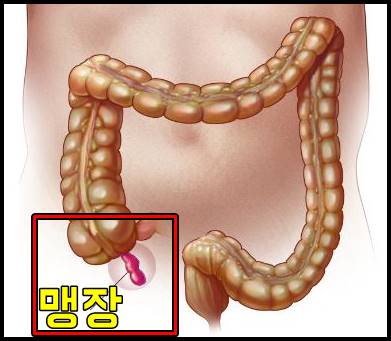 맹장염