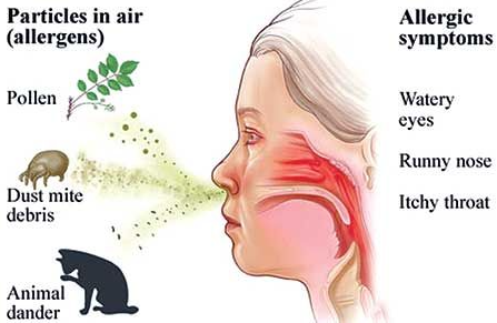 알레르기 비염 증상 원인(사진출처 : Pinterest)