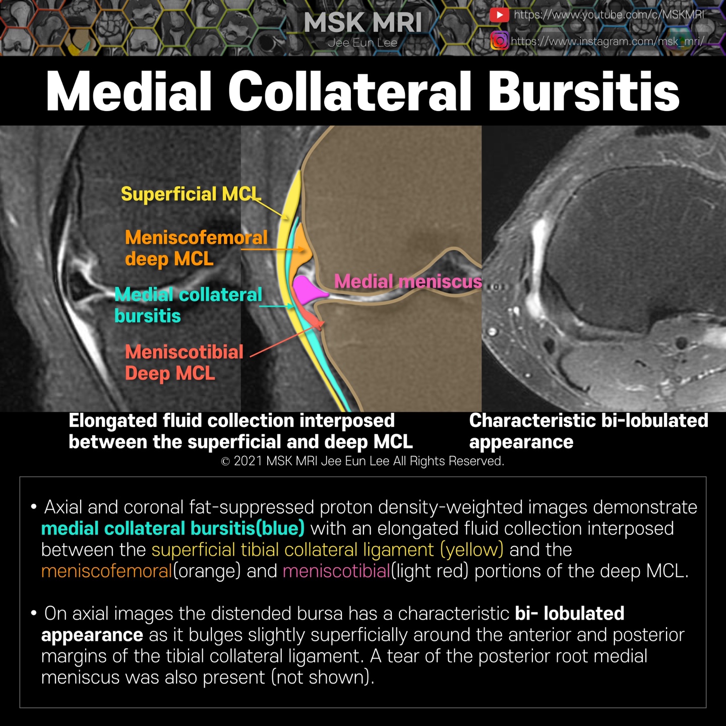 medial collateral ligament mri