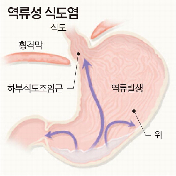 역류성식도염 이미지