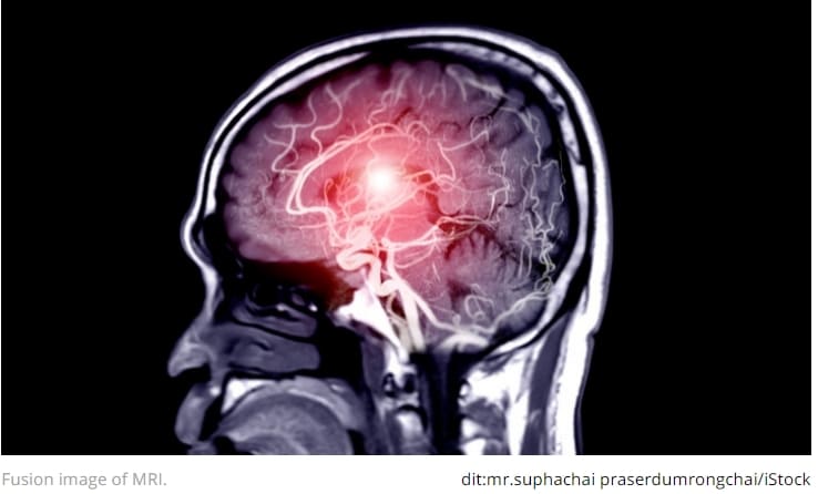  MRI로 세계 최초 뇌 염증 촬영 성공 Scientists used magnetic resonance imaging to show brain inflammation in vivo for the first time