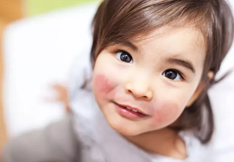 아이 볼에 나타난 붉은 발진 '제5병'일 가능성 알아보기