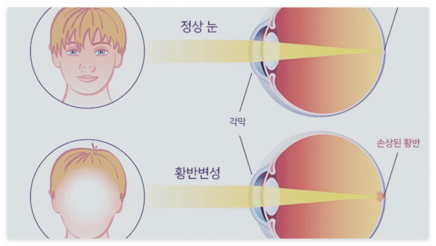 황반변성-원인-증상-치료법-주사가격