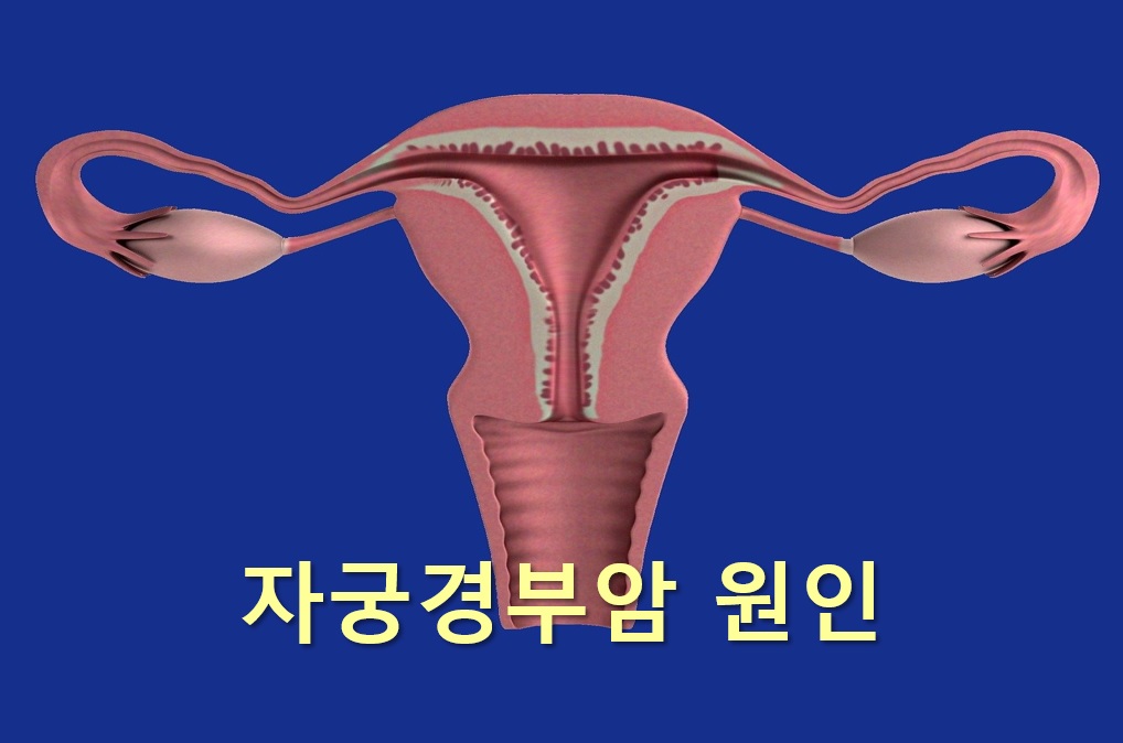  자궁경부암 증상과 자궁경부암 원인