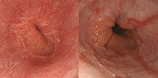 정상식도(왼쪽)와 역류성 식도염 내시경 진단 영상