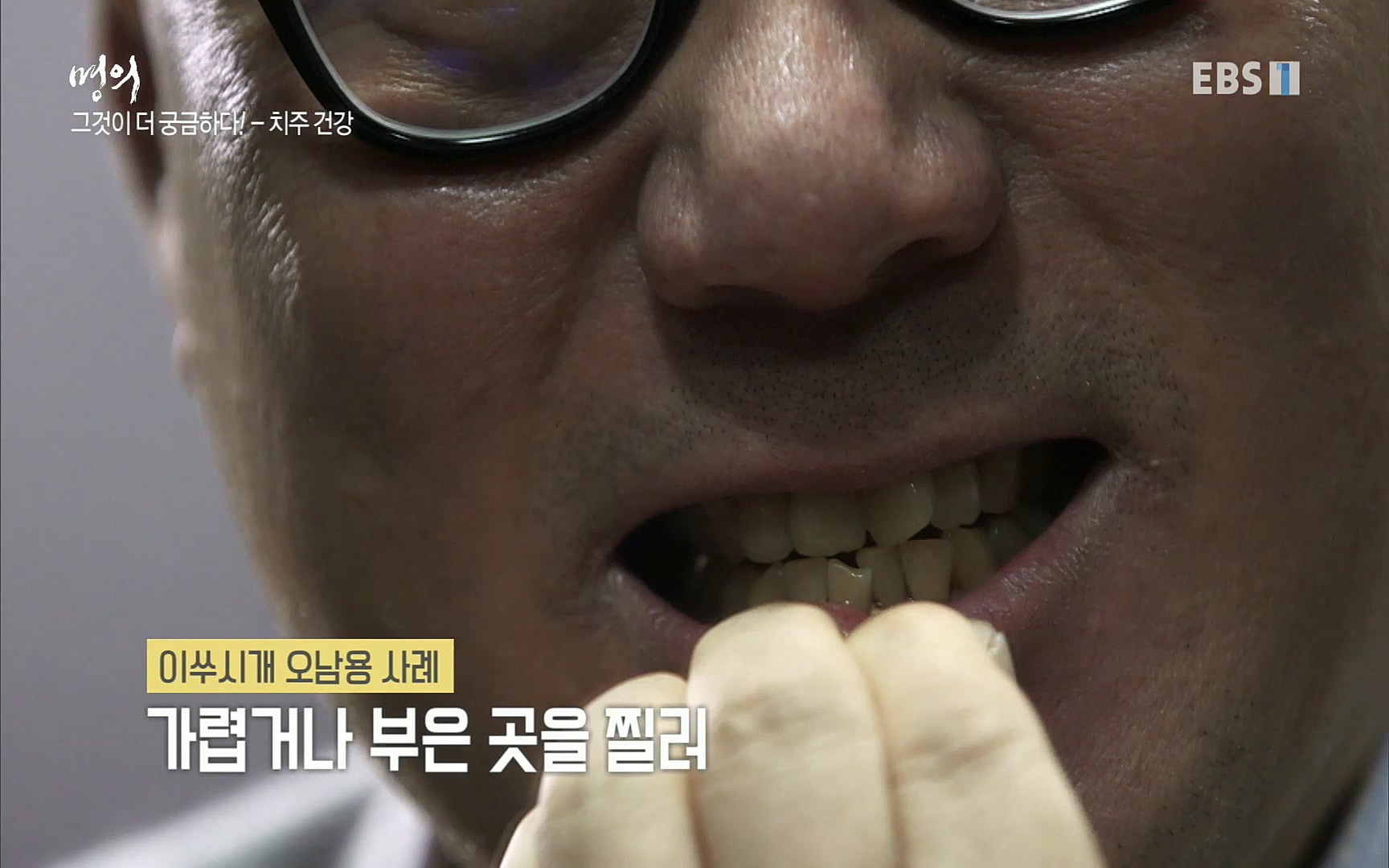 EBS 명의 헬스케어 - TV - 교육의 중심 EBS치주염이 코로나로 소홀해진 구강관리가 치아를 더 망가트리고 위험하게 만들며, 증상이 없기 때문에 특히 더 조심하고 치은염 단계에서 진행되지 않도록 예방해야한다 정의원 교수님과 치_20220505_151730.211.jpg