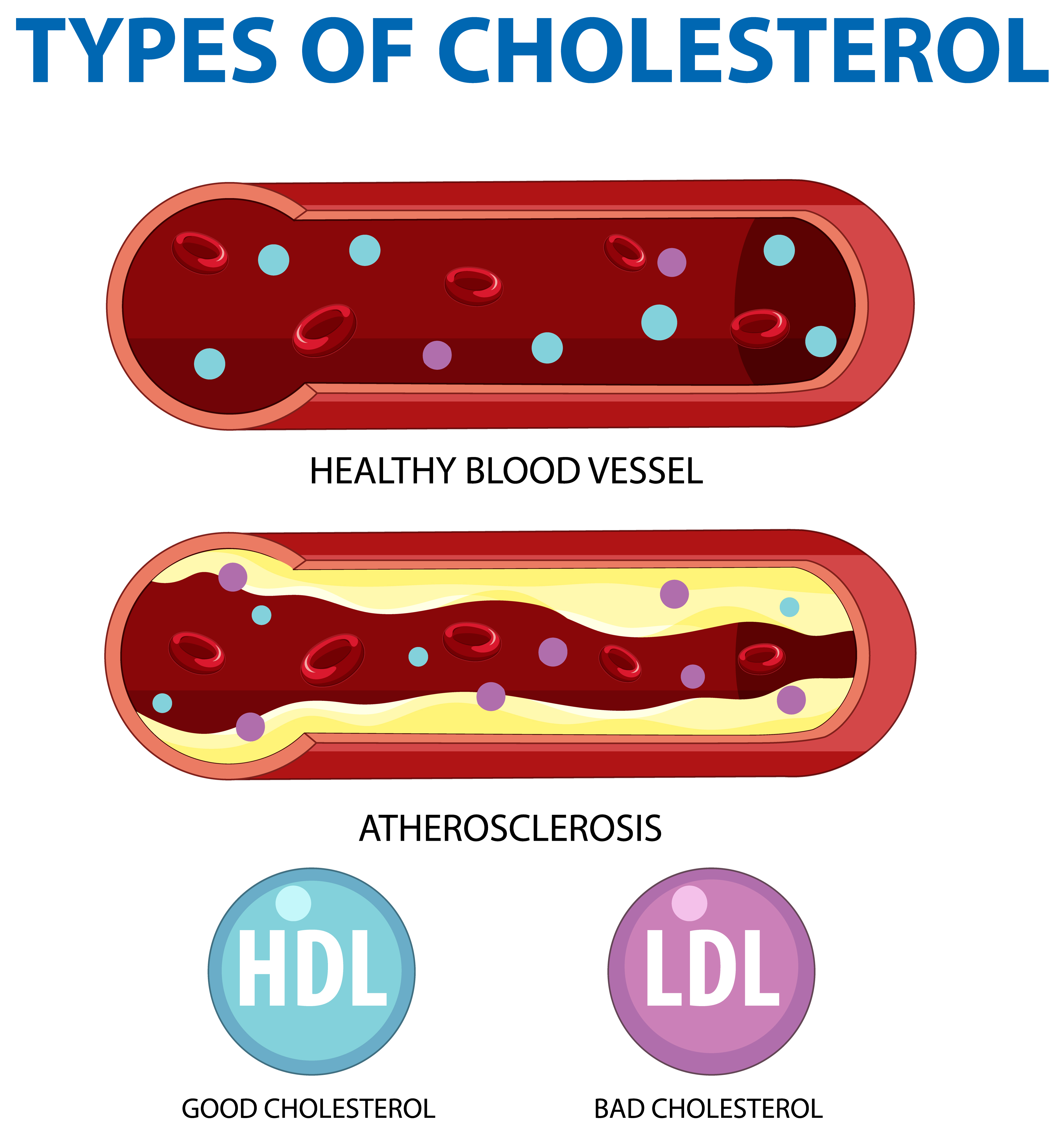 HDL은 착한 콜레스테롤&#44; LDL은 나쁜 콜레스테롤