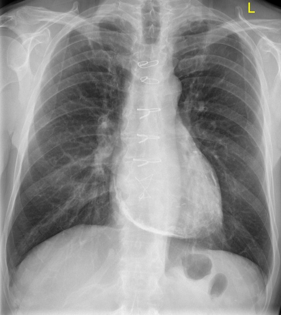교착성심낭염 constrictive pericardits의 엑스레이 사진
석회화된 심낭확인가능함