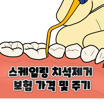  스케일링 치석제거 보험 가격 및 주기 발생원인 알려드려요