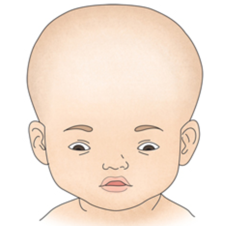 척수수막류의 증상과 원인 - 척수수막류의 증상 척수수막류의 증상과 원인 - 척수수막류의 증상