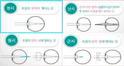 [건강칼럼]정시, 근시, 원시, 난시란? 2