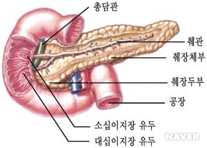 췌장염 
췌장