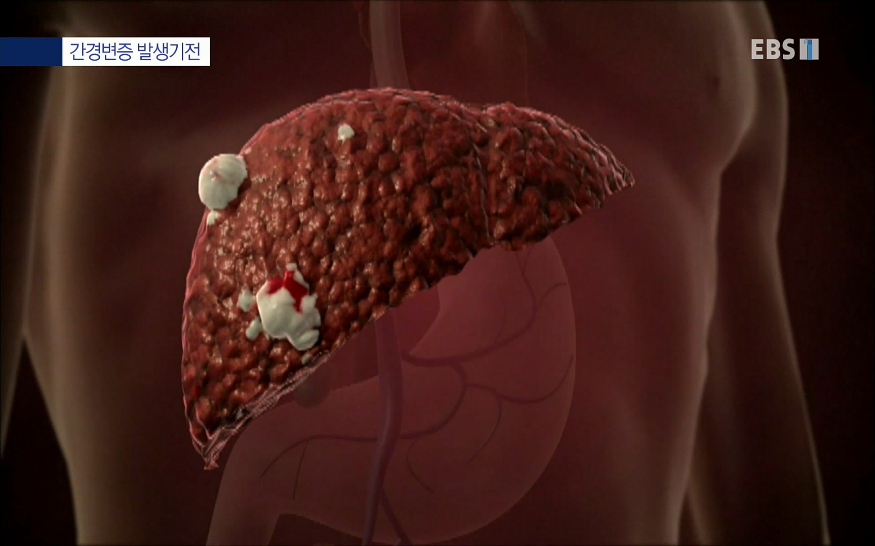 EBS 명의 헬스케어 - TV - 교육의 중심 EBS명의 15년 - 간, 완치에 도전하다.mp4_20220802_202416.495.jpg