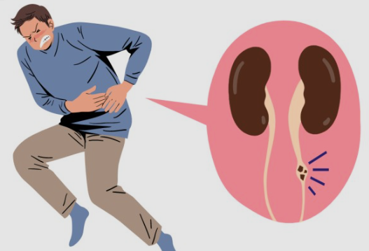  언제 올지모르는 요로결석 예방하는 방법!