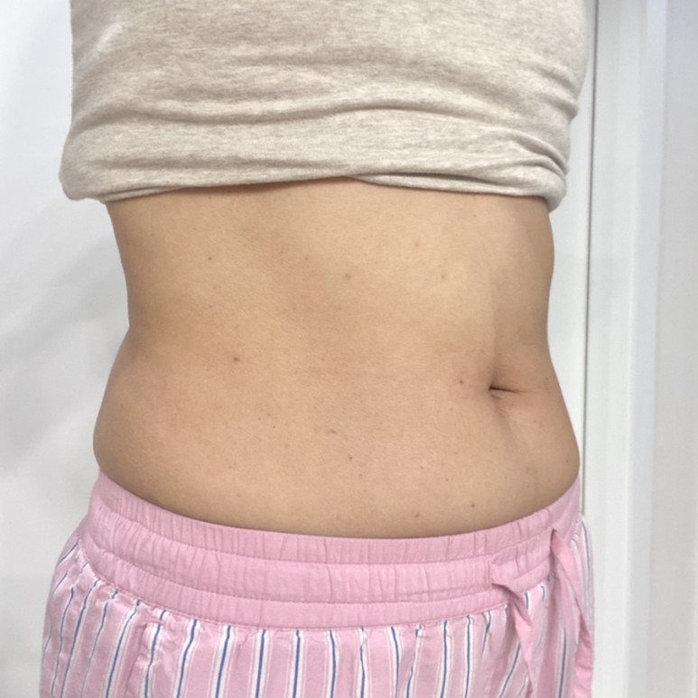 한달째 배살빼는법 실행결과 복부지방분해주사 - 10