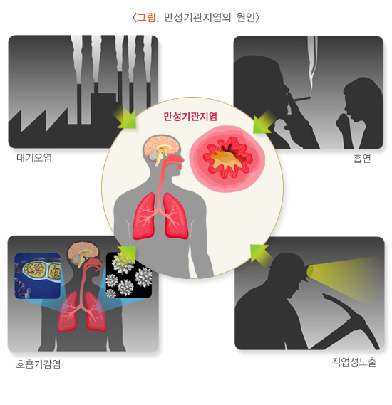  만성기관지염 증상과 치료 방법