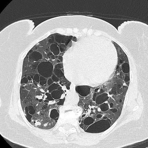 Pulmonary Langerhans cell histiocytosis