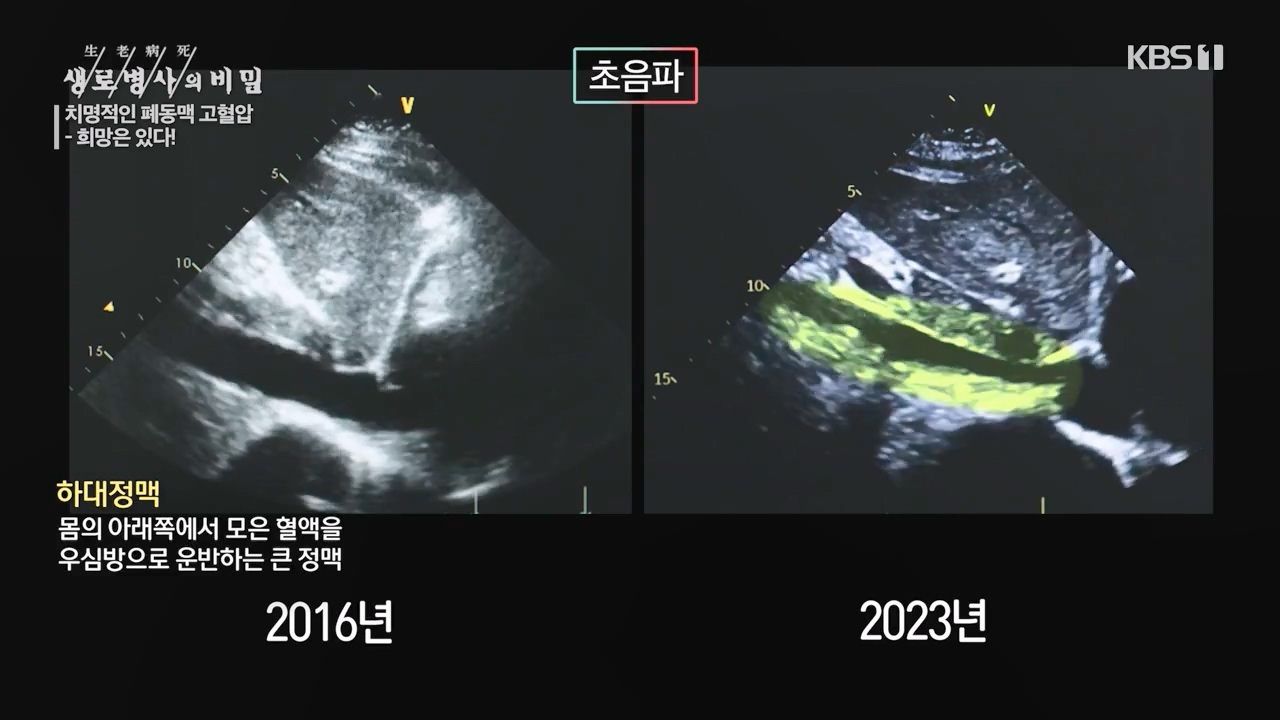 생로병사의 비밀.E900.240215p-NEXT.mp4_20240215_202543.386.jpg