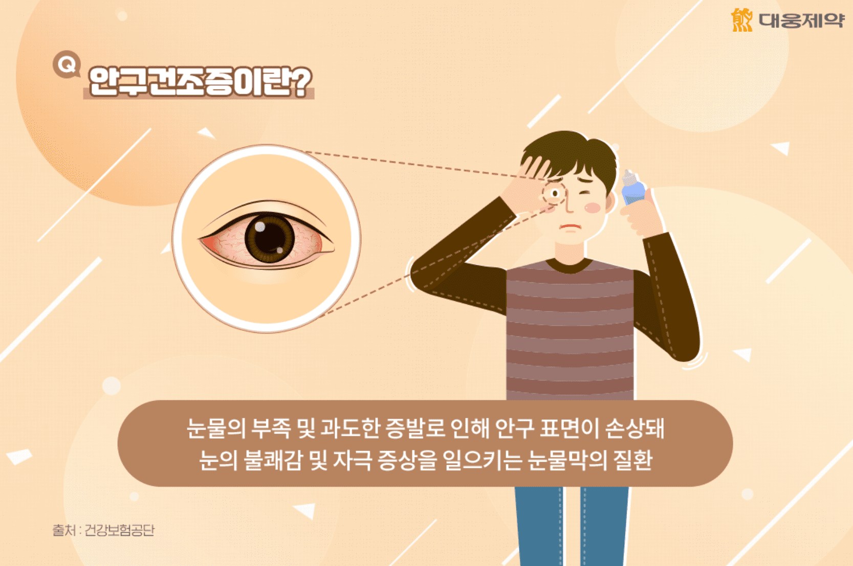 콘드로이친 효능&#44; 부작용과 팁 - 안구건조증 이미지