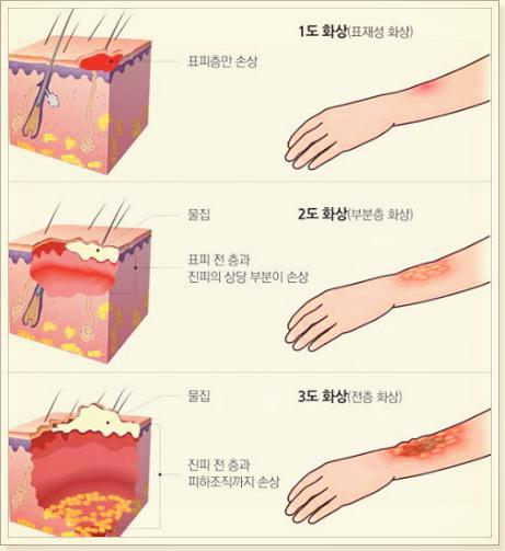  화상 응급처치  A부터 Z까지