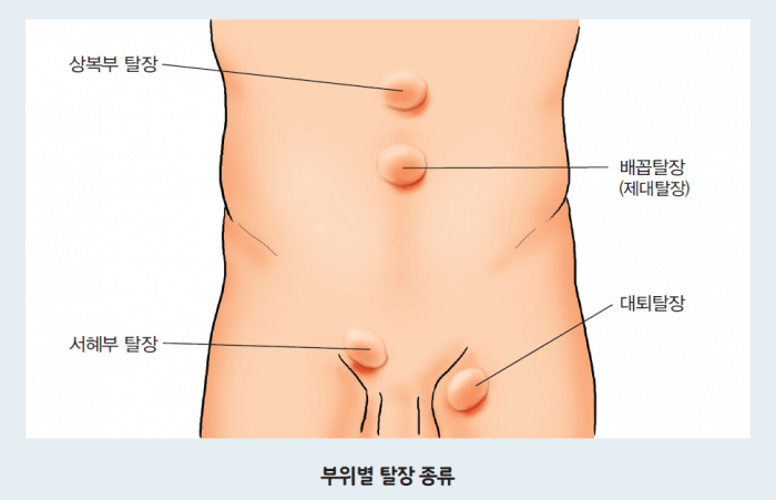 스포츠 탈장