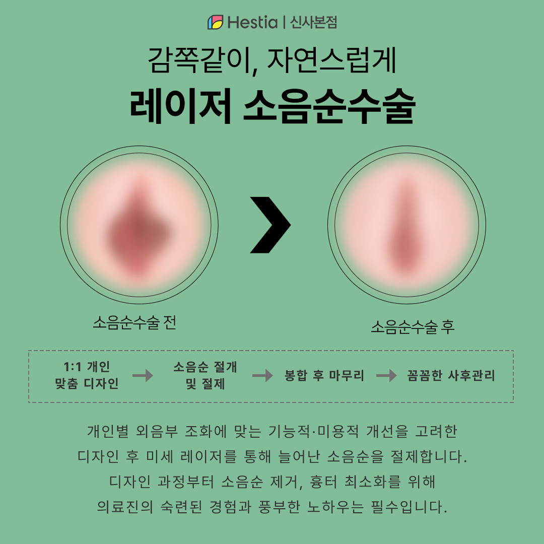 자연스러운 소음순성형수술