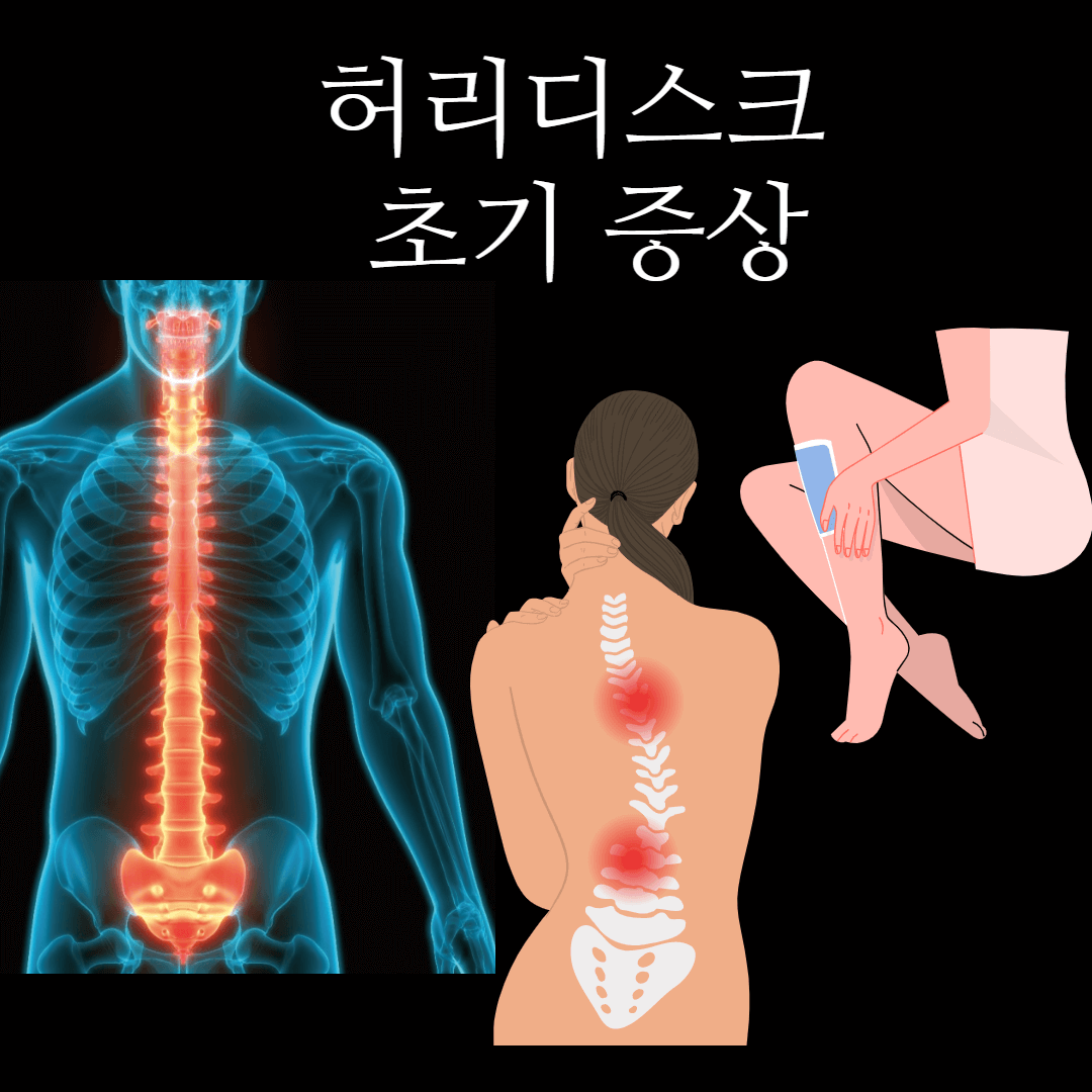 허리디스크 초기증상