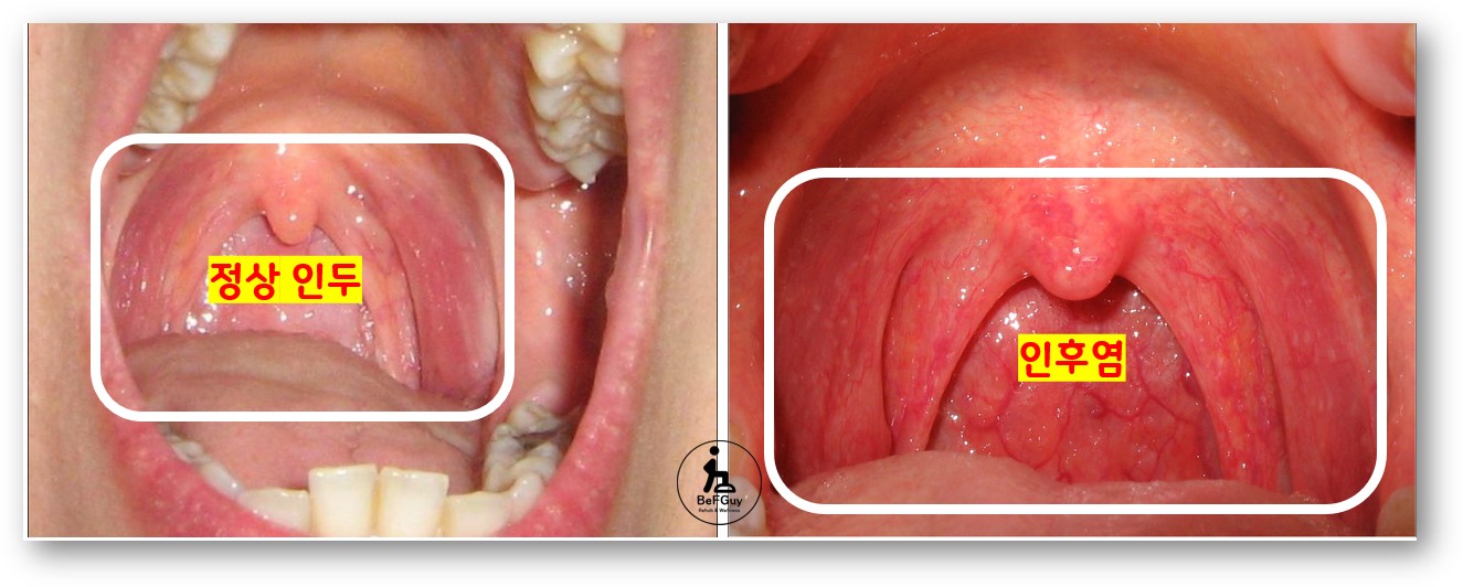 인후염 확인 방법