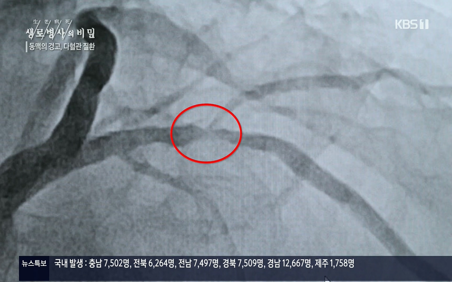 생로병사의 비밀.E831.220817p.H264-F1RST.mp4_20220822_185311.592.jpg