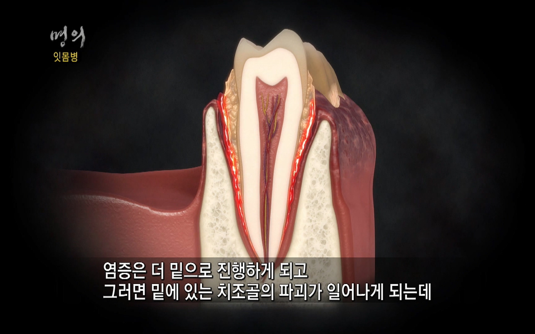 EBS 명의 헬스케어 - TV - 교육의 중심 EBS2015년 1월 16일 (금) 밤 9시 50분, EBS1.mp4_20220505_150354.522.jpg