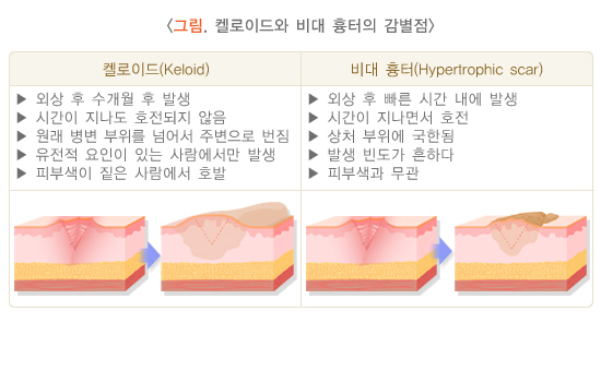  켈로이드