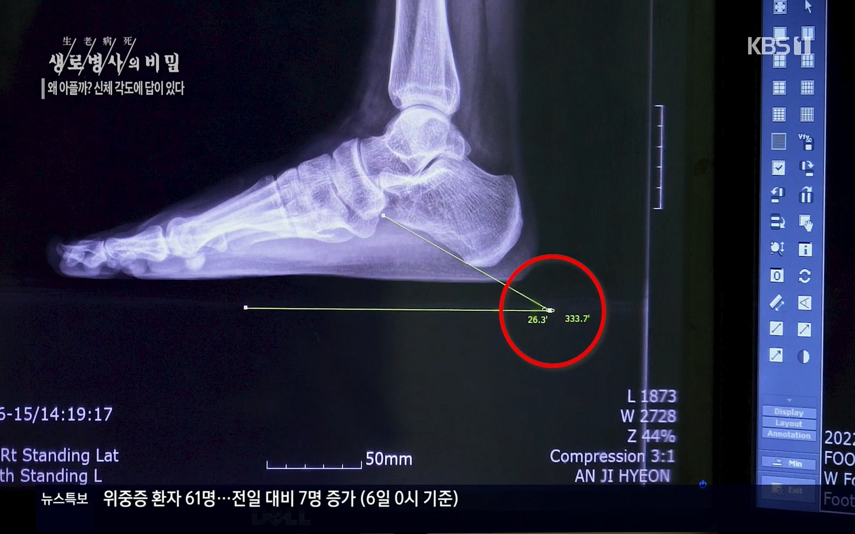 생로병사의 비밀.E825.220706p.H264-F1RST.mp4_20220707_185802.229.jpg