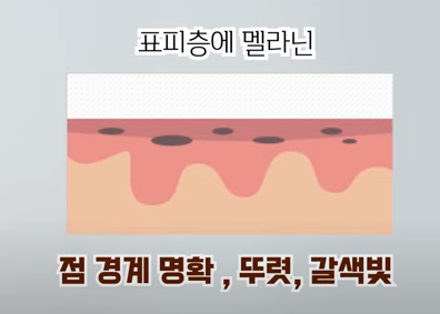  점의 종류와 치료방법은 어떤게 있을까..??