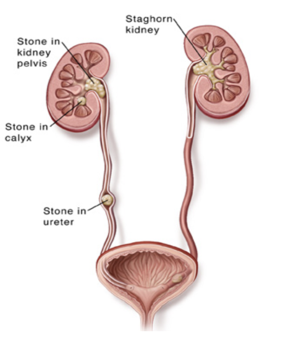 등을 두드리면 아픈 증상, 갈비 3