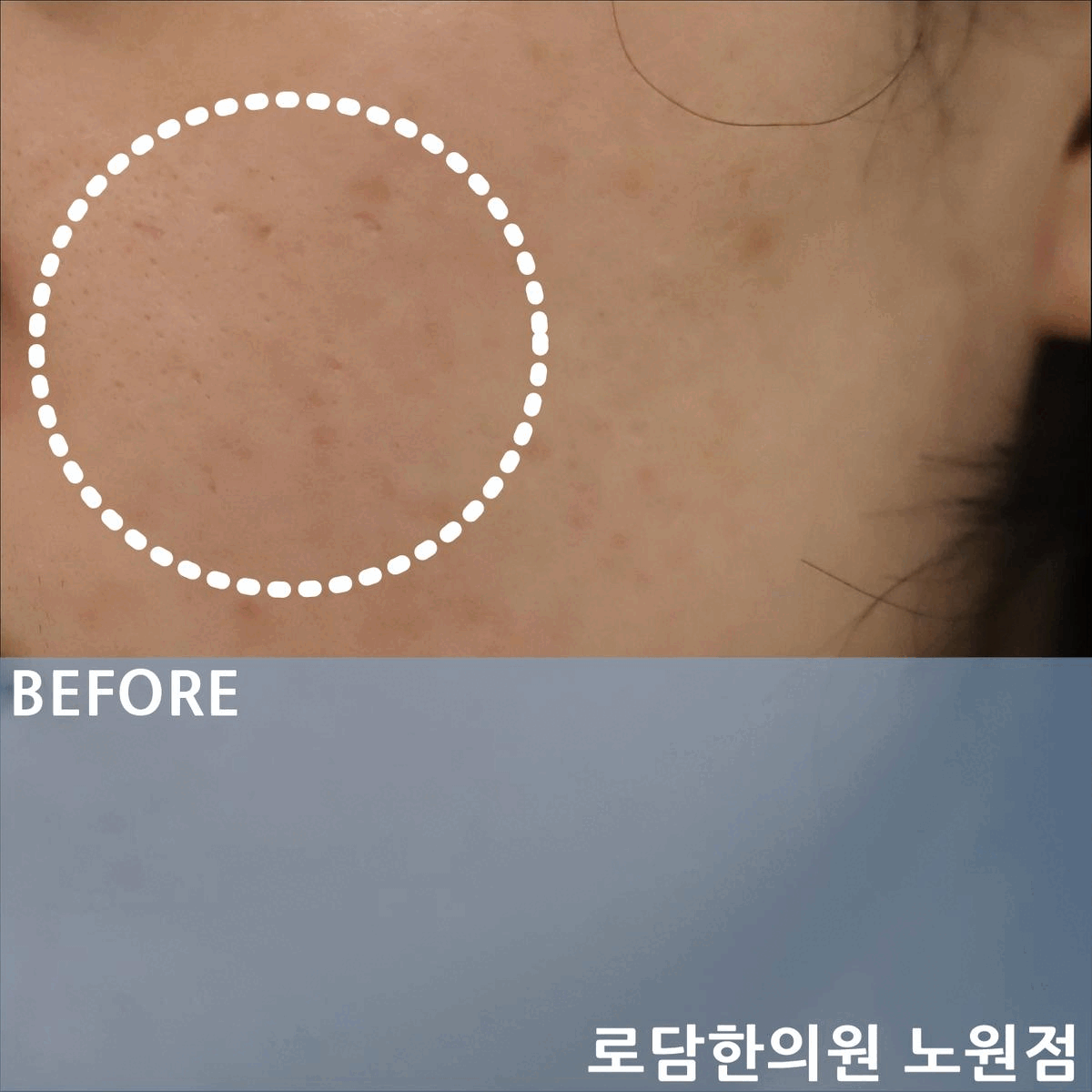  여드름 패인 흉터 치료 새살침 한의원 과정에 대하여