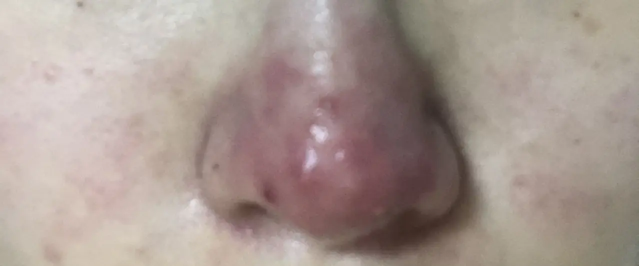 코 피부염