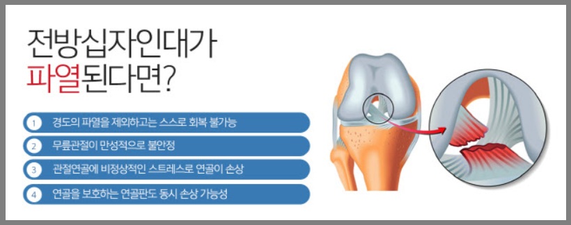 전방십자인대파열된다면 수술