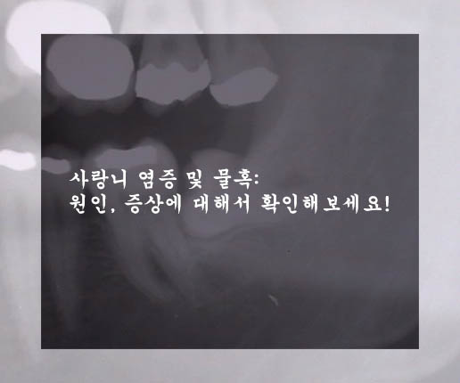  사랑니 염증 및 물혹: 원인, 증상에 대해서 확인해보세요!