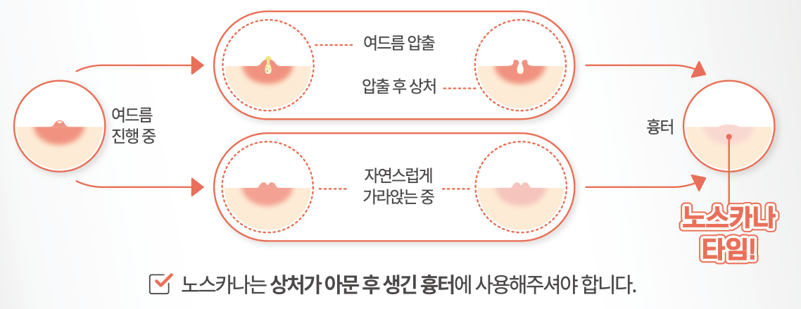 노스카나겔