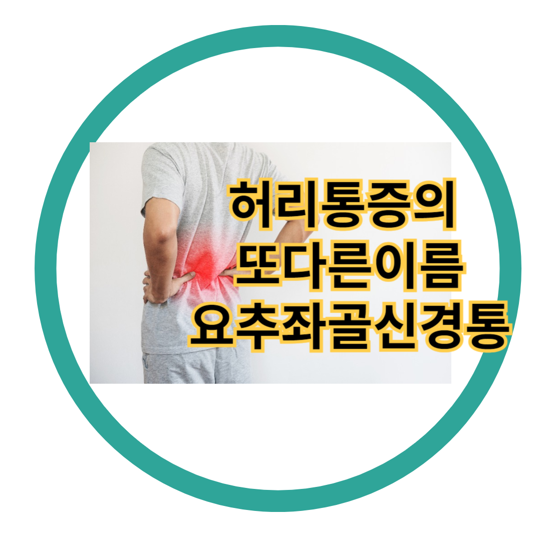요추좌골신경통