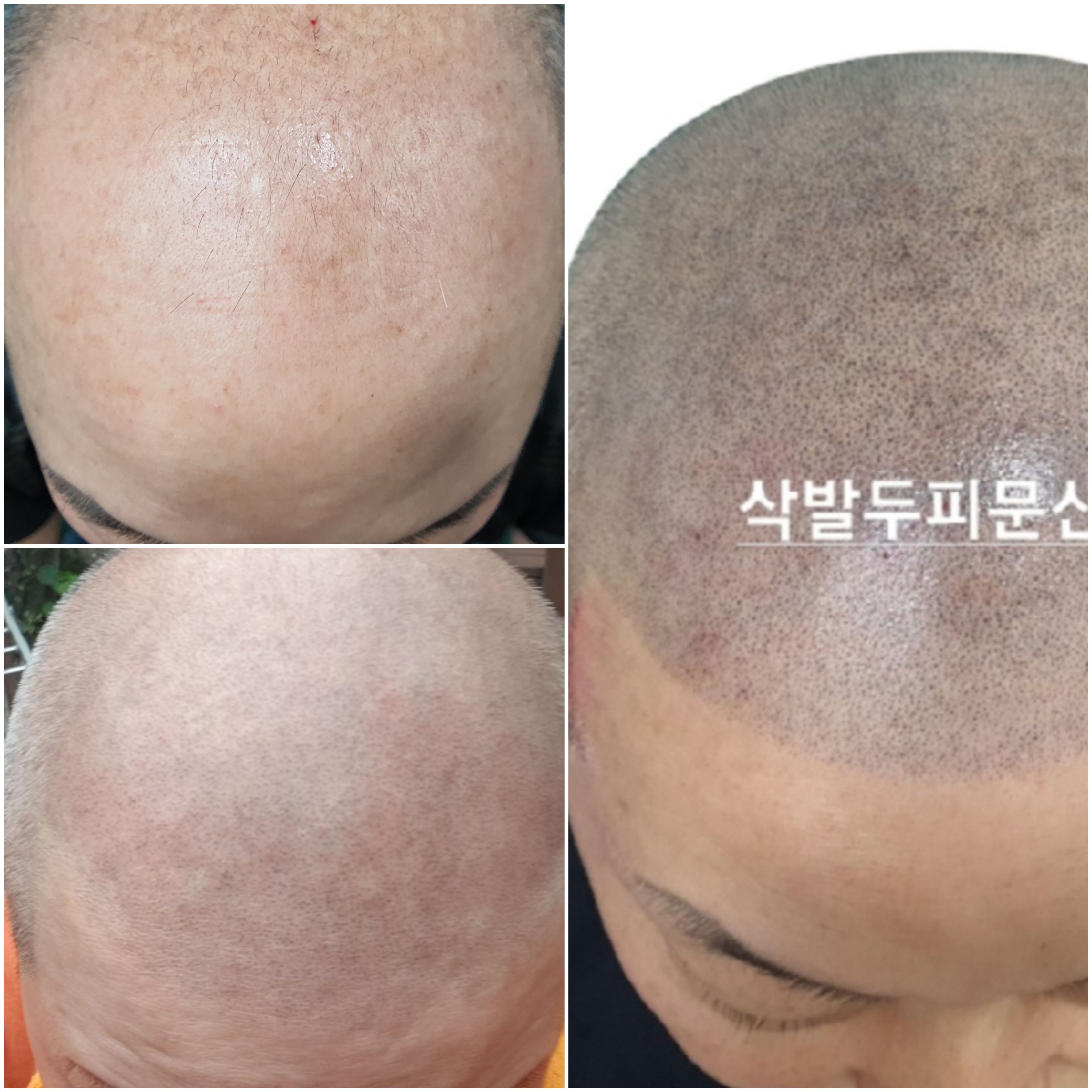  전주 두피문신 대머리 탈모문신 극복 smp 2021-11-12 22:36:57