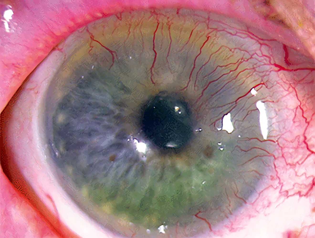 Neovascular disease caused by wearing contact lenses for a long time