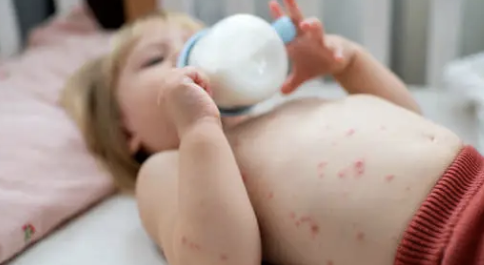수두 증상 3