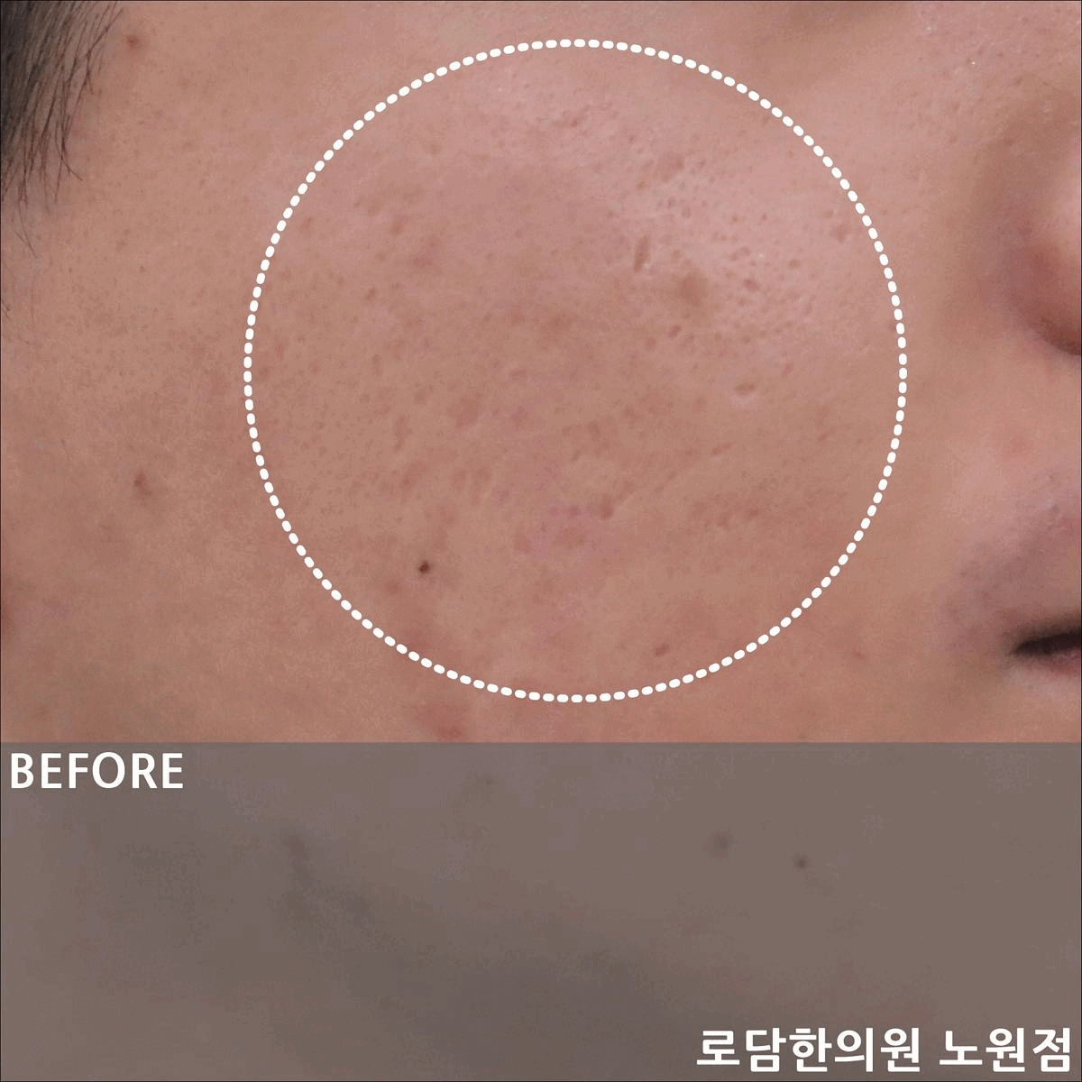  노원 여드름 흉터 치료 파인 자국 새살침 코라테라피 과정
