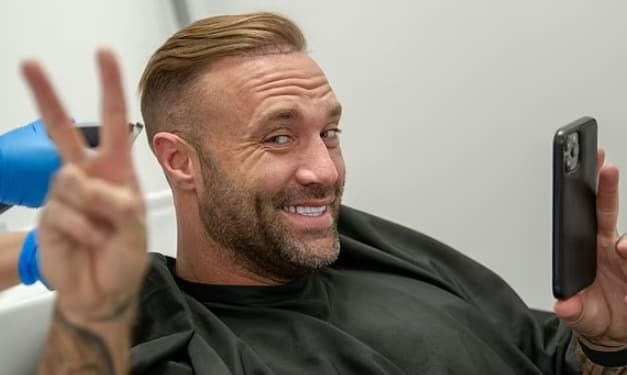 목 털로 6번이나 모발이식한 영국 유명 방송인 VIDEO: Calum Best undergoes another transplant using hair from his BEARD