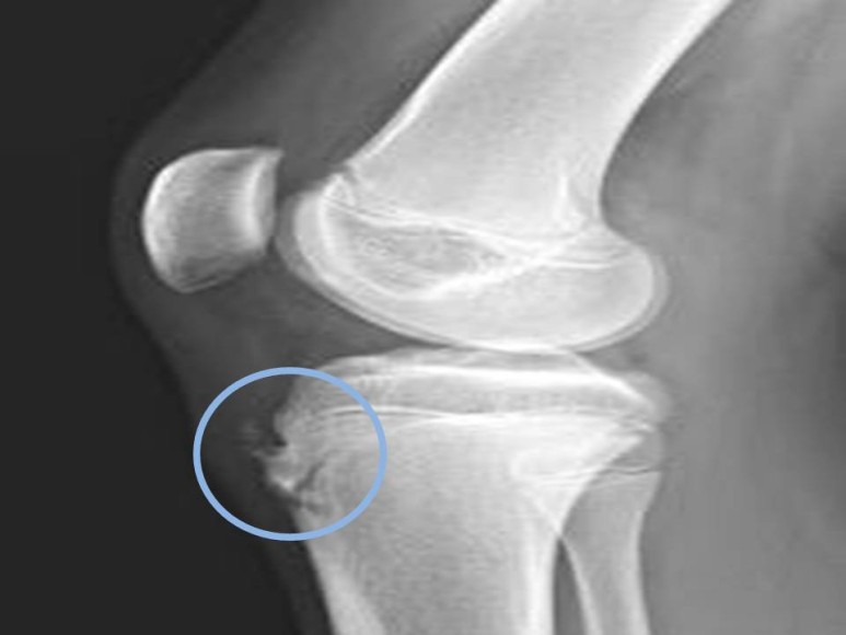 성장통 / 오스굿-슐라터병(Osgood-Schlatter disease) 양산 통증클리닉 - 5