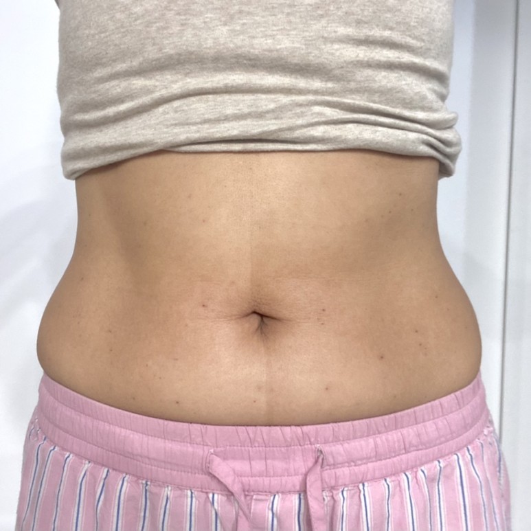 한달째 배살빼는법 실행결과 복부지방분해주사 - 9