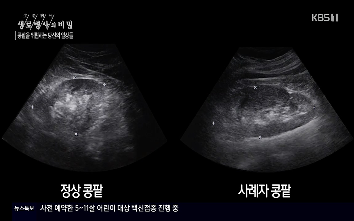 생로병사의 비밀.E819.220421p-NEXT.mp4_20220421_191204.773.jpg